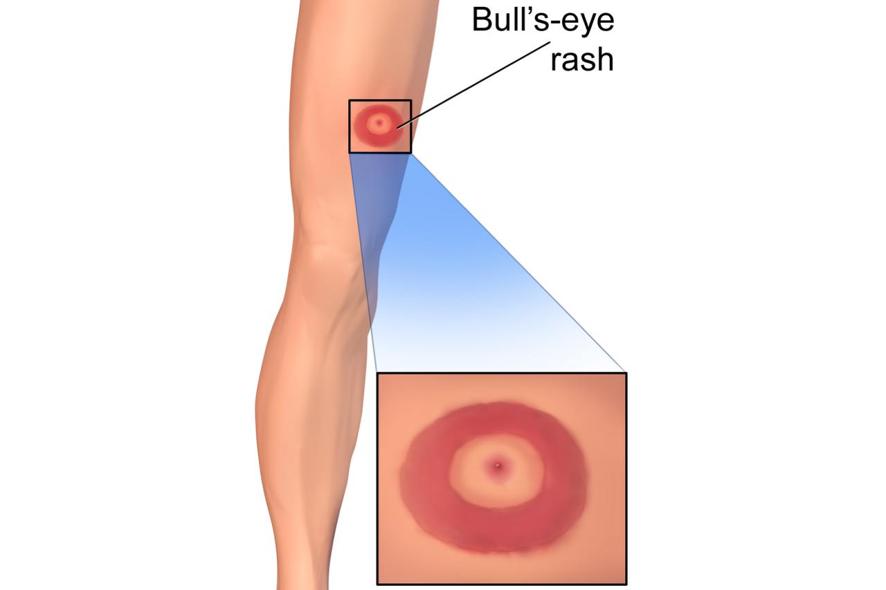 national-lyme-disease-risk-map-saunace national-lyme-disease-risk-map-saunace