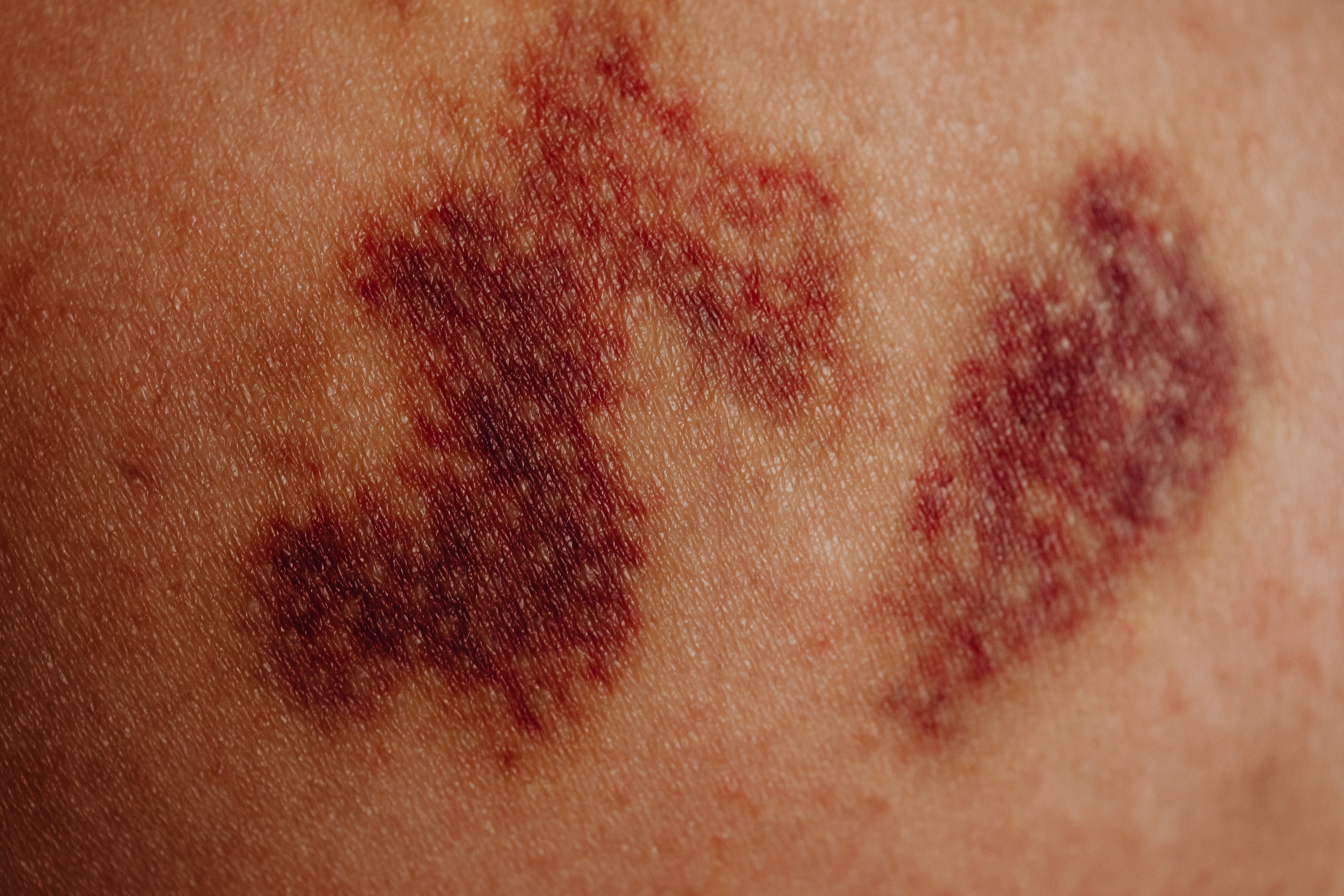Red rash on skin, illustrating eczema or irritation related to infrared sauna use Red rash on skin, illustrating eczema or irritation related to infrared sauna use