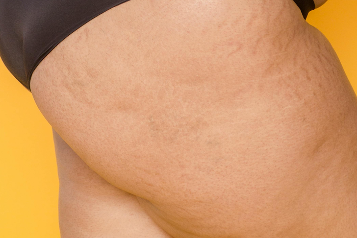 the-battle-against-cellulite the-battle-against-cellulite